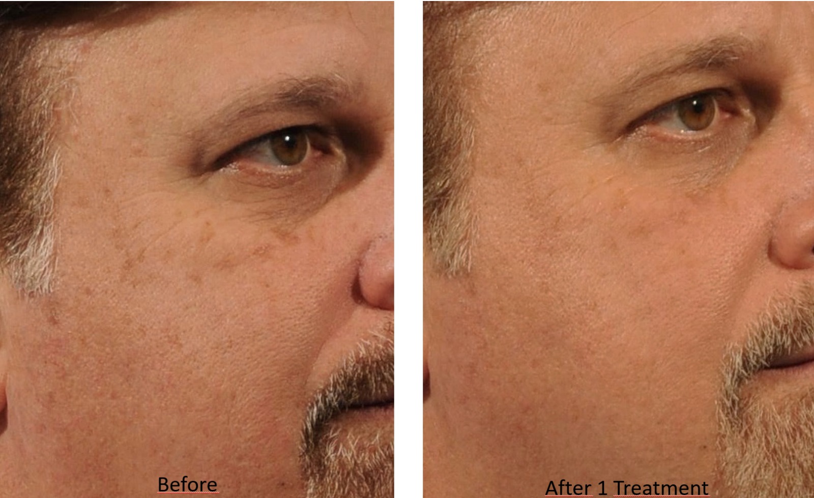 LaseMD Ultra Before and After - Skin Rejuvenation